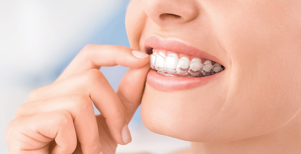 Invisalign"